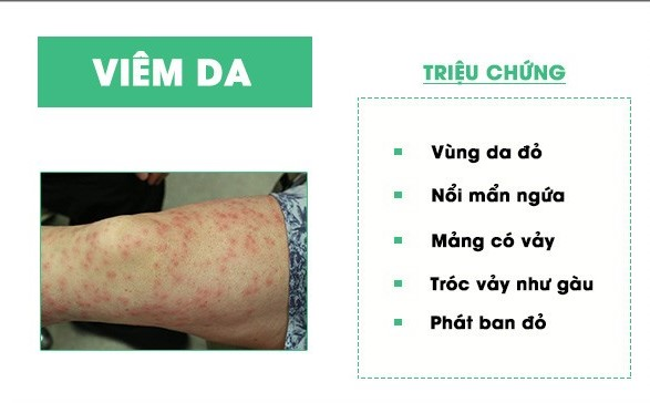 CÁC BỆNH DA LIỄU THƯỜNG GẶP