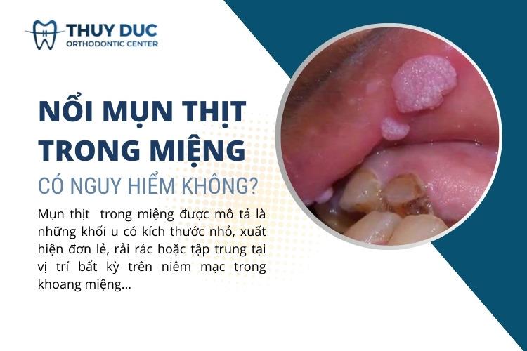 Nổi mụn thịt trong miệng không đau có nguy hiểm không?