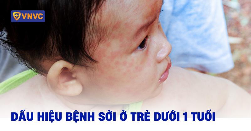 dấu hiệu bệnh sởi ở trẻ dưới 1 tuổi