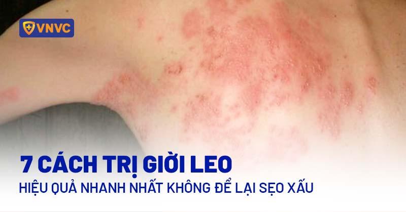 cách trị giời leo