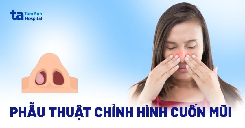 phẫu thuật chỉnh hình cuốn mũi