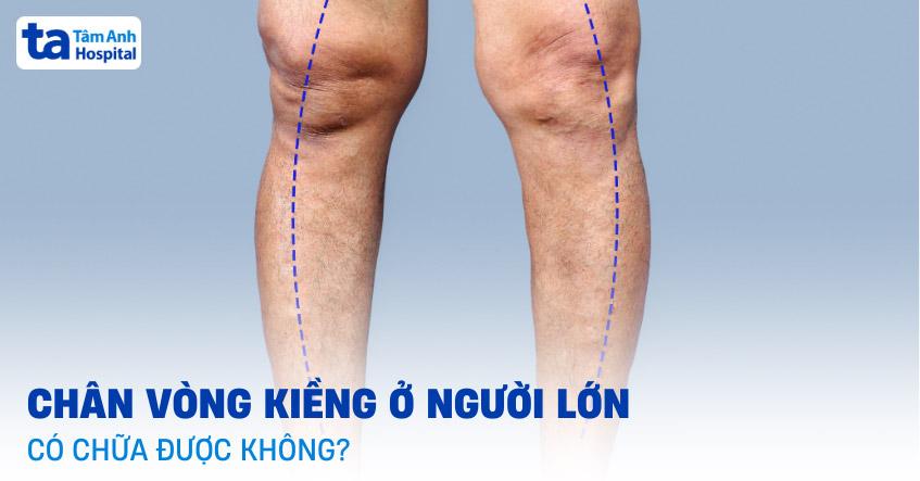 Chân vòng kiềng ở người lớn có chữa được không? Nguyên nhân là gì?