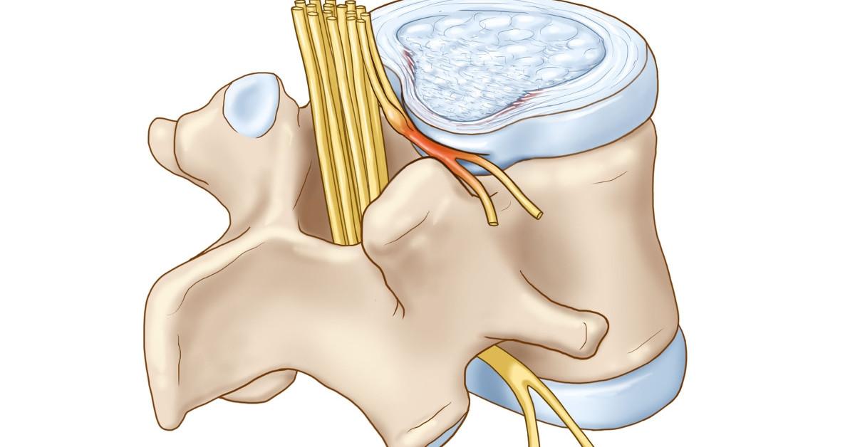 Chèn ép dây thần kinh: Nguyên nhân, triệu chứng và cách điều trị