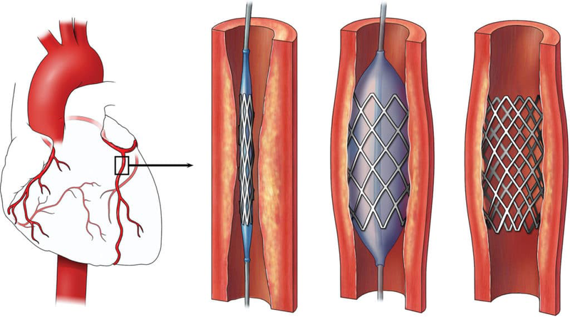 Chi phí đặt stent mạch vành có mắc không?