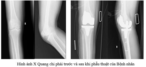 BỆNH VIỆN ĐA KHOA KHU VỰC CỦ CHI:  PHẪU THUẬT THAY KHỚP GỐI NHÂN TẠO CHO BỆNH NHÂN THOÁI HOÁ KHỚP GỐI NẶNG