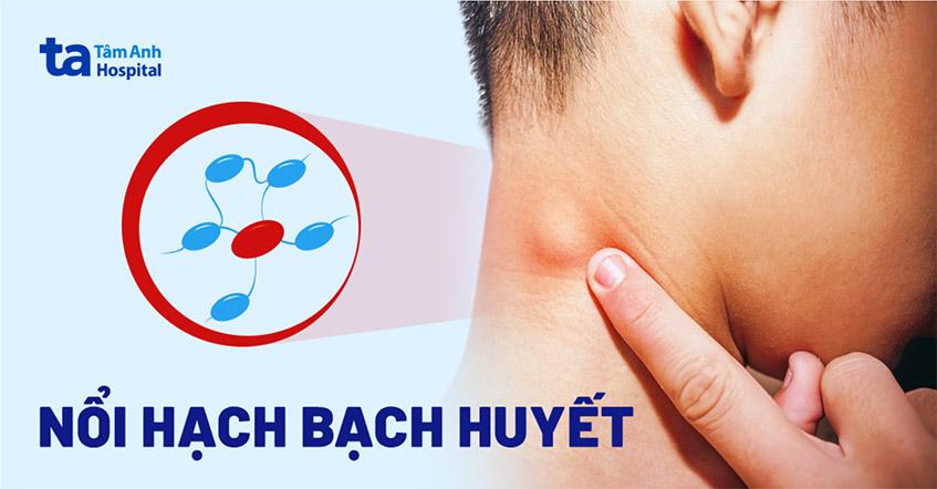 Sưng, nổi hạch bạch huyết: Nguyên nhân dấu hiệu và cách điều trị