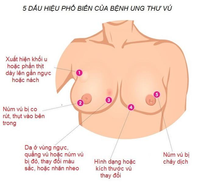 CHẨN ĐOÁN VÀ ĐIỀU TRỊ UNG THƯ VÚ