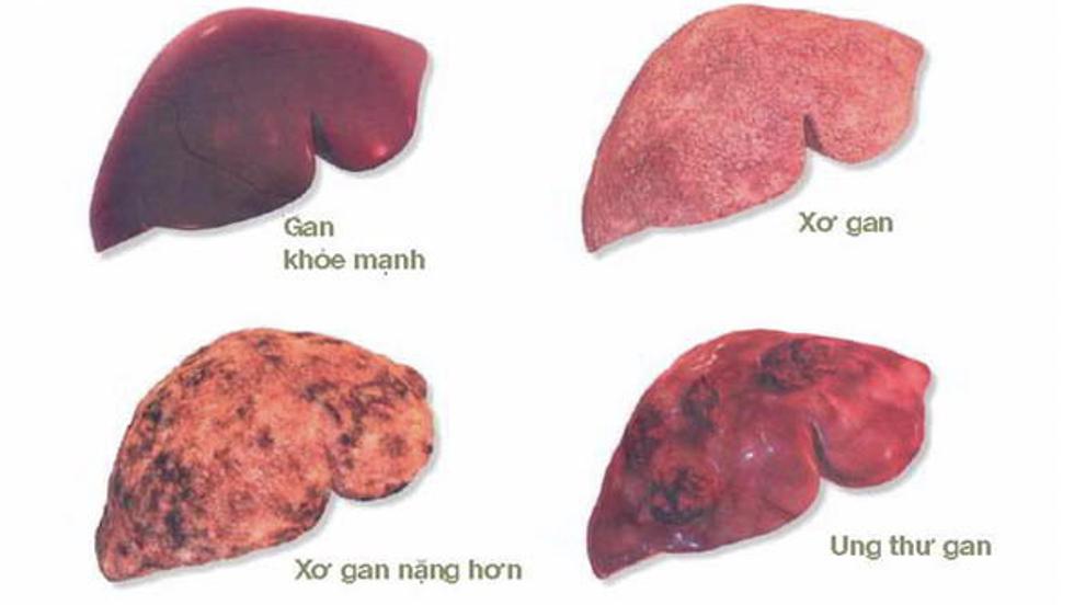 Ung thư gan  - Yếu tố nguy cơ và đối tượng cần tầm soát