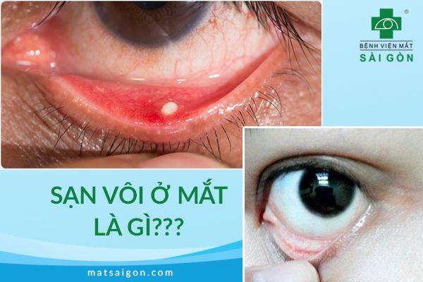 Sạn vôi ở mắt: Triệu chứng và cách điều trị