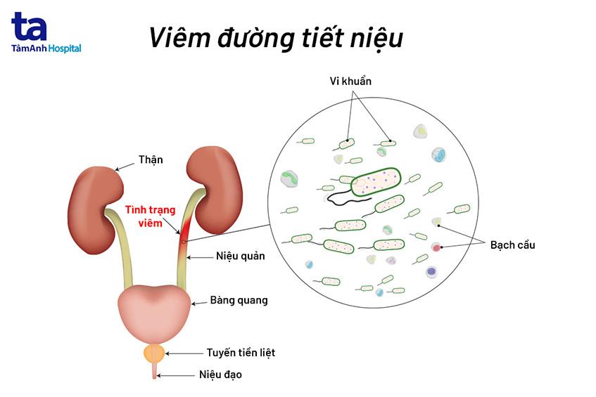 Viêm đường tiết niệu: Nguyên nhân, triệu chứng, chẩn đoán và điều trị