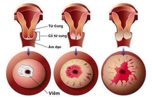 Cách điều trị viêm lộ tuyến cổ tử cung độ 1