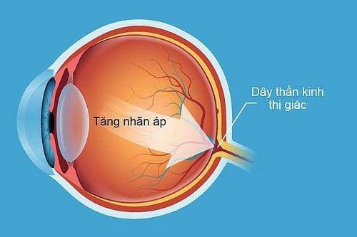 Thường xuyên đau đầu cảnh báo bệnh gì?