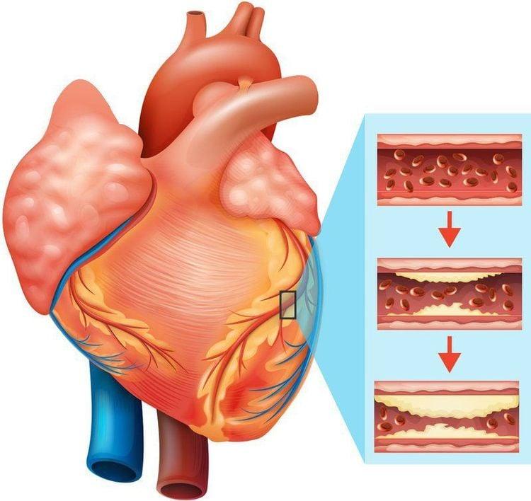 Bệnh mạch vành: Biểu hiện, nguyên nhân và cách điều trị ở Vinmec