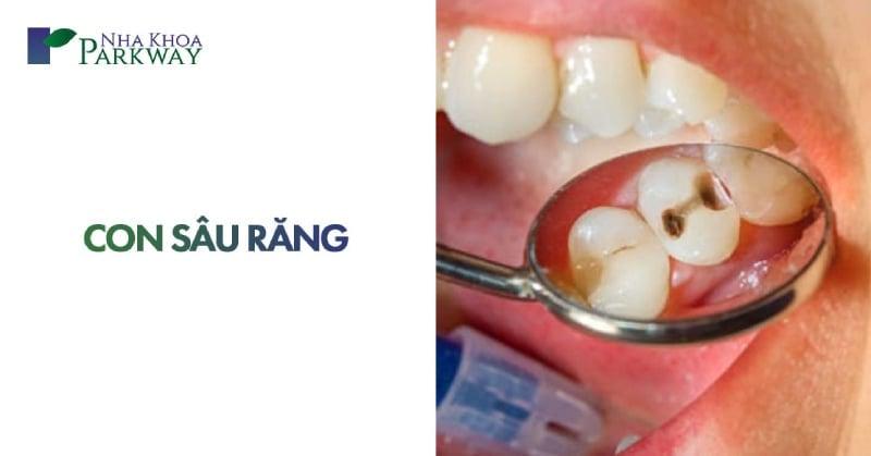 Bác sĩ dùng gương nha để khám tổng quát chiếc răng sâu của bệnh nhên