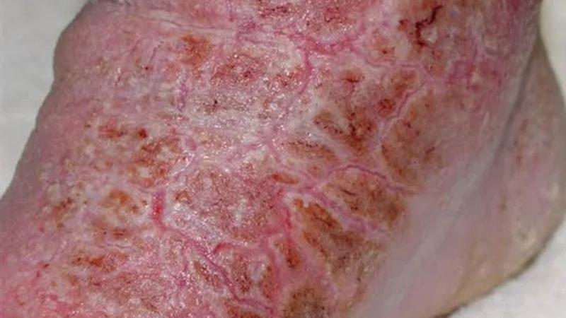 Morgellons là bệnh gì? Nguyên nhân và cách điều trị bệnh