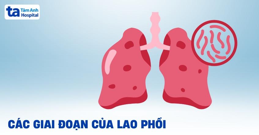 Các giai đoạn của lao phổi, nhận biết sớm và nắm rõ tiến triển bệnh