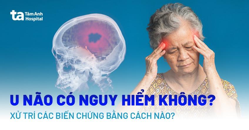 Bệnh u não có nguy hiểm không? 9 biến chứng thường gặp và cách xử trí