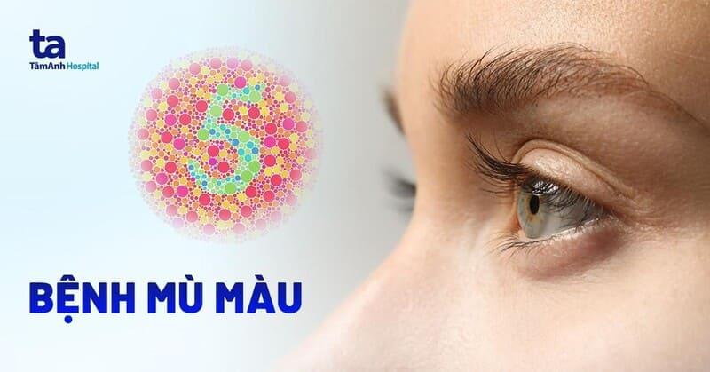 Bệnh mù màu: Nguyên nhân, triệu chứng, chẩn đoán và điều trị