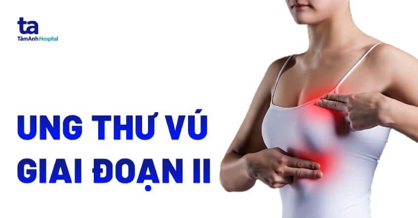 Ung thư vú giai đoạn 2: Triệu chứng, điều trị và tiên lượng