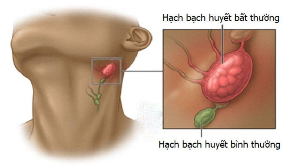 Sưng hạch bạch huyết