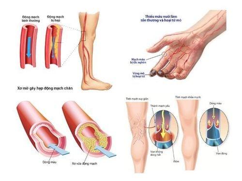 Bệnh Buerger là một trong những nguyên nhân gây nên tình trạng viêm các mạch máu ở chân và tay, đặc biệt vùng bàn tay bàn chân