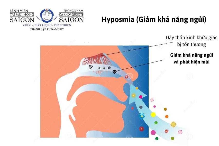 Triệu chứng viêm xoang thường gặp Hyposima (chứng khó ngửi)