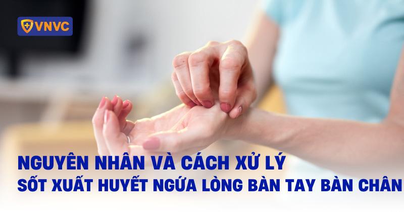 sốt xuất huyết ngứa lòng bàn tay bàn chân