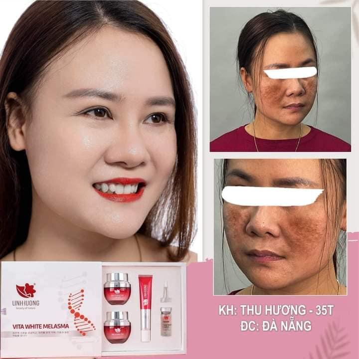 Bộ trị nám Linh Hương