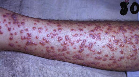 Smallpox blisters on an arm.