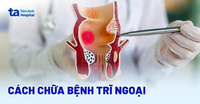 cách chữa bệnh trĩ ngoại