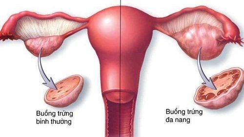 Nếu mắc hội chứng buồng trứng đa nang, bạn có thể trải qua chu kỳ kinh nguyệt không đều